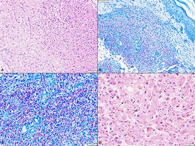 Features of Hemophagocytic Lymphohistiocytosis in Infants With Severe Combined Immunodeficiency: Our Experience From Chandigarh, North India